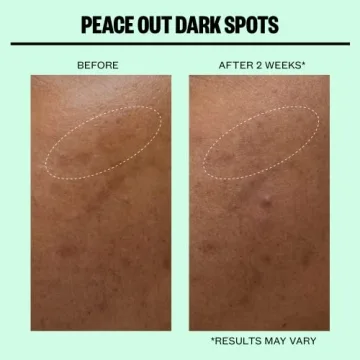 Peace Out Skincare Dark Spots Microstructure Dots
