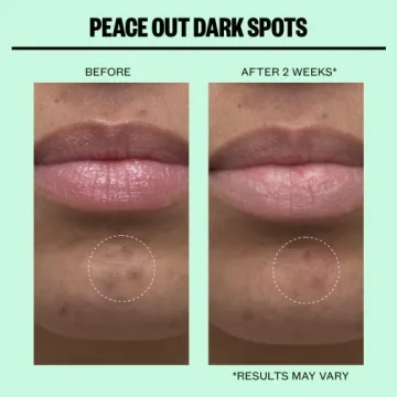 Peace Out Skincare Dark Spots Microstructure Dots