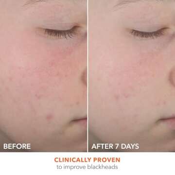 Dr Dennis Gross Alpha Beta On the Spot Eliminator & 2% BHA Breakout Solution Bundle