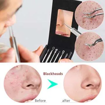 Pimple Popper Tool Kit for Blackhead and Acne Removal