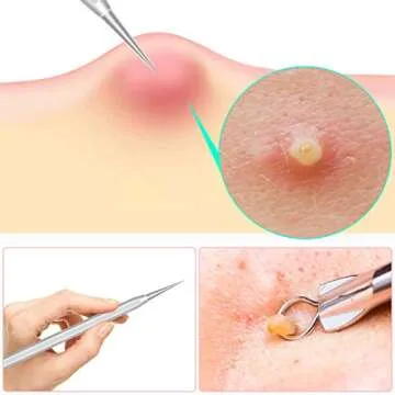 Pimple Popper Tool Kit for Blackhead and Acne Removal