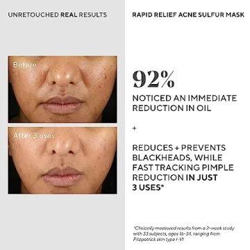 Murad Acne Sulfur Mask - Quick Relief for Breakouts