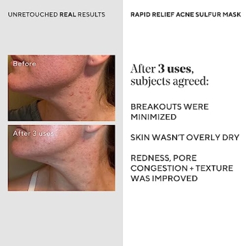 Murad Acne Sulfur Mask - Quick Relief for Breakouts