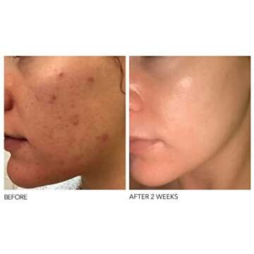 Dr. Dennis Gross Alpha Beta Extra Strength Daily Peel: for Oily Skin, Uneven Tone or Texture, Wrinkles or Enlarged Pores (5 Treatments)