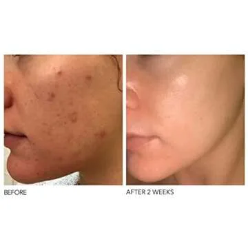 Dr. Dennis Gross Alpha Beta Extra Strength Daily Peel: for Oily Skin, Uneven Tone or Texture, Wrinkles or Enlarged Pores (5 Treatments)