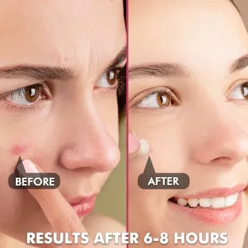 Invisible Pimple Patches - Non-Irritating Hydrocolloid Acne Care