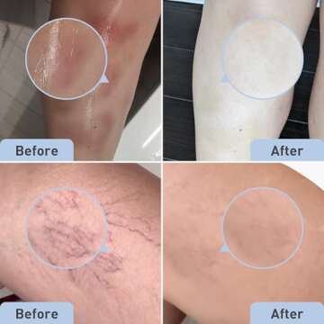 PROcure Bruise Remedy Gel with Arnica, Helps Improve the Appearance of Bruises & Spider Veins on the Foot and Ankle, Unscented & Paraben Free with Soft Touch Applicator, 2 Fl Oz