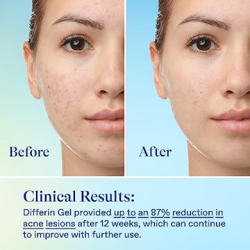 Differin Acne Skin Care Kit for Flawless Skin