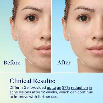 Differin Acne Skin Care Kit for Flawless Skin