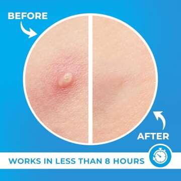 PatchRx Pimple Patches for Face (240 Patches), Hydrocolloid Acne Patches with Tea Tree Oil, Pimple Patch Pimple Stickers - Hydrocolloid Patch Acne Dots - Acne Pimple Patches For Face - Zit Patches