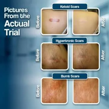 Medical Grade Silicone Scar Sheets for Fast Healing