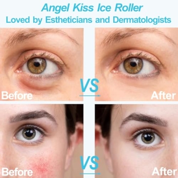 Angel Kiss Ice Roller for Face & Eye | Skincare Gift