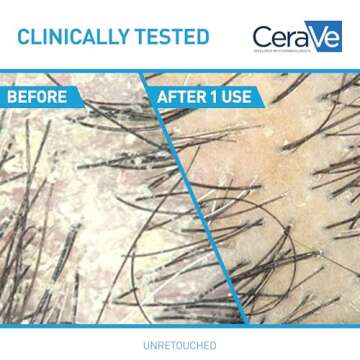 CeraVe Hydrating Anti Dandruff Conditioner, 0.5% Pyrithione Zinc Dandruff Treatment With Ceramides, Hyaluronic Acid & Niacinamide, Helps Eliminate Flakes & Reduce Itchy Scalp, Sulfate Free Conditioner