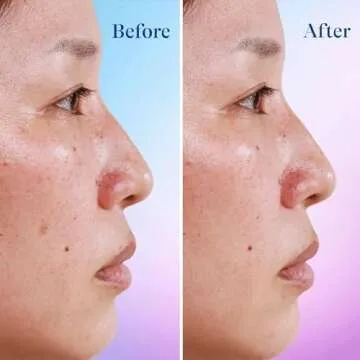 Differin Dark Spot Correcting Face Serum, Dark Spot Correcting Serum by the makers of Differin Gel, Gentle Skin Care for Acne Prone Sensitive Skin, 1 oz (Packaging May Vary)