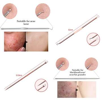 ZTRHYOO Blackhead Remover Pimple Comedone Extractor Tool Best Acne Removal Kit - Treatment for Blemish, Whitehead Popping, Zit Removing for Risk Free Nose Face Skin with Case(Rose, 4 Piece Set)