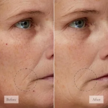 Philosophy Vitamin C Resurfacing Peel Kit for Radiance