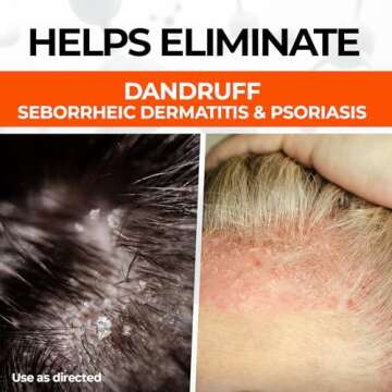 Medicasp Coal Tar Shampoo for Dandruff Relief 6 oz