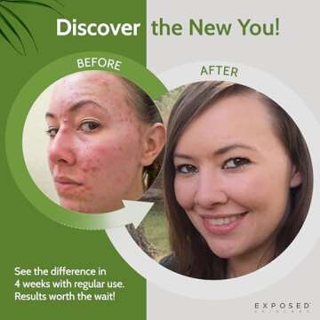 Exposed Skin Care Acne Treatment Kit - Includes Facial Cleanser, Clearing Tonic, Acne Treatment Seru...