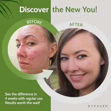 Exposed Skin Care Acne Treatment Kit - Includes Facial Cleanser, Clearing Tonic, Acne Treatment Seru...