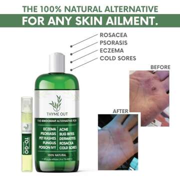 All Natural Eczema Treatment- Psoriasis Treatment - an All-in-One Solution for Acne, Dermatitis, Ros...