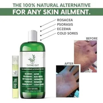 All Natural Eczema Treatment- Psoriasis Treatment - an All-in-One Solution for Acne, Dermatitis, Ros...