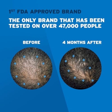 Men's Rogaine Foam for Hair Regrowth, 5% Minoxidil Treatment