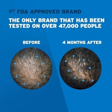 Men's Rogaine Foam for Hair Regrowth, 5% Minoxidil Treatment