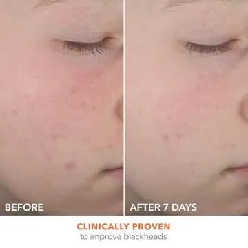 Dr Dennis Gross Alpha Beta® On The Spot Eliminator, 2% Salicylic Acid Spot Treatment, 1 Fl Oz