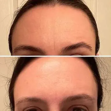 Frownies Forehead & Eye Patches - Natural Anti-Aging Solution