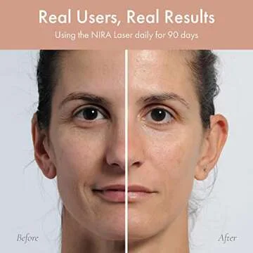 NIRA Skincare Laser & Serum Bundle - Includes Anti-Aging Laser & Hyaluronic Acid Serum - Reduces Appearance of Fine Lines & Wrinkles - FDA Cleared