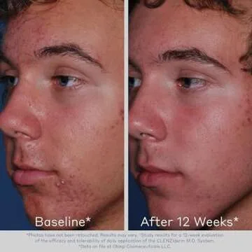 Obagi Foaming Acne Cleanser with 2% Salicylic Acid