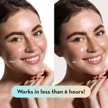 LE GUSHE Korean Pimple Patches for Face (78 Dots) - Hydrocolloid Acne Patches with Tea Tree Oil - Invisible Zit Stickers - Dermatologist Tested - Korean Skin Care