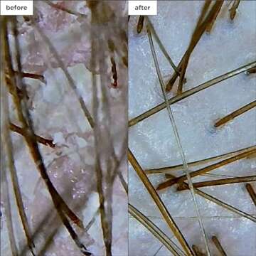 Briogeo Scalp Revival Megastrength Dandruff Shampoo, Charcoal + AHA/BHA with Salicylic Acid 3%, Anti-Dandruff Shampoo to Soothe a Dry, Flaky, Itchy Scalp, Vegan, Cruelty-Free, 8.4 fl oz