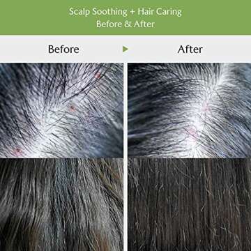 LA'DOR Hair Conditioner - Tea Tree Scalp Clinic Hair Pack, 6.76 Fl Oz - Calming & Nourishing with Snail Mucin, Green Tea, Aloe for Itchy Sensitive Dry Flaky Damaged Scalp