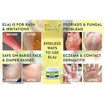 ELAJ All Natural Eczema Skin Care Moisturizing Lotion Cream for Safe Relief