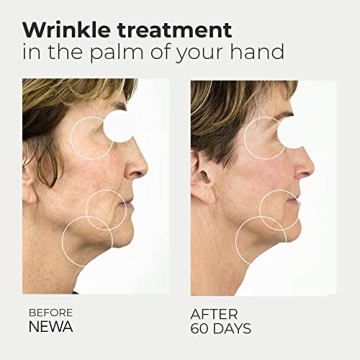 NEWA RF Wrinkle Reduction Device for Youthful Skin