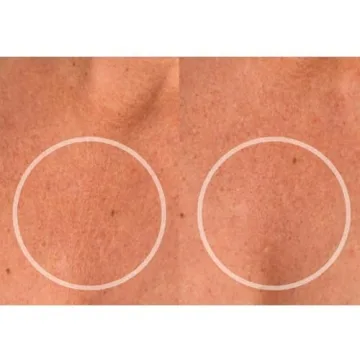 SiO Beauty ChestLift Anti-Wrinkle Patches for Youthful Skin