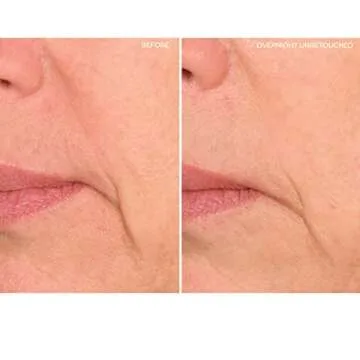 SiO Beauty Super LipLift Anti-Wrinkle Lip Patches - 4 Week Supply