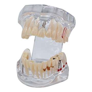Transparent Teeth Model - Removable Adult Tooth Study Model, Typodont Pathological Disease Implant T...