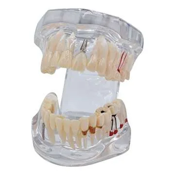 Transparent Teeth Model - Removable Adult Tooth Study Model, Typodont Pathological Disease Implant T...