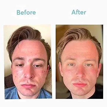 MDacne Skin Clearing Vitamins for Healthy, Clear Skin