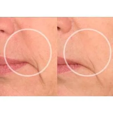 SiO Beauty Eye & Smile Lift - Eye & Smile Anti-Wrinkle Patches 2 Week Supply - Overnight Smoothing Silicone Patches for Wrinkles and Fine Lines