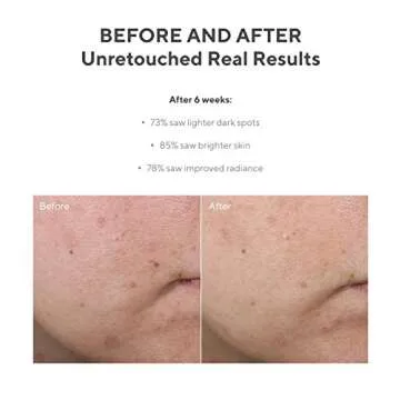 Murad Environmental Shield Rapid Age Spot Correcting Serum - Clinically Proven Skin Correction Age Spot Serum for Dark Spot Pigment Lightening - Hydroquinone Alternative Serum, 1.0 Fl Oz