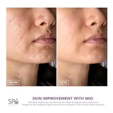 Spa Sciences MIO Microdermabrasion for Radiant Skin