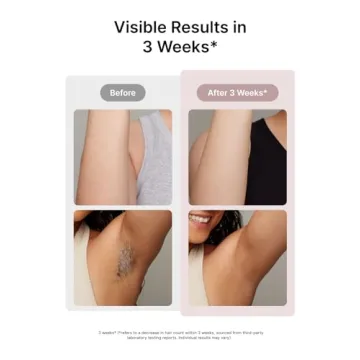 Ulike Air 3 IPL Hair Removal Device – Smooth Skin at Home