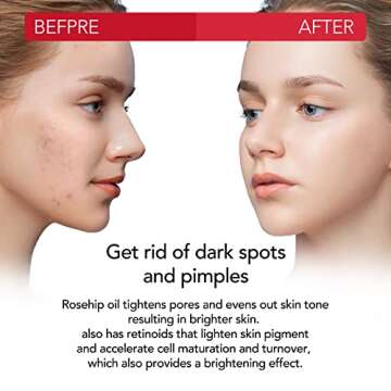 SUPSERSR Rosehip Oil, Organic Rosehip Seed Oil Anti-Aging Natural Cold Pressed Unrefined For Face, Hair, Nail, Scar, All Skin & Hair Types