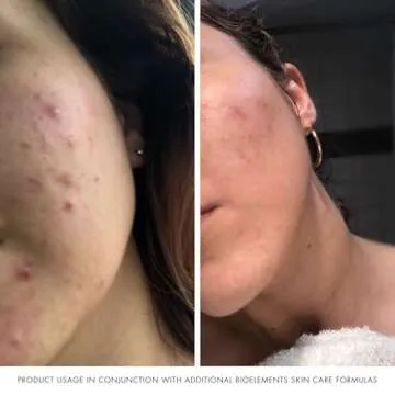 Bioelements Moisture Positive Cleanser - Rich Facial Cleanser for Dry Skin - Vegan, Gluten Free - Never Tested on Animals, 6 Fl Oz (Pack of 1)