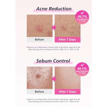 EasyDerm Real Calming Pimple Patches | Niacinamide, Hyaluronic Acid, Panthenol, EGF | Transparent Micropoint, Acne Spot Care, K-beauty | 6 Count