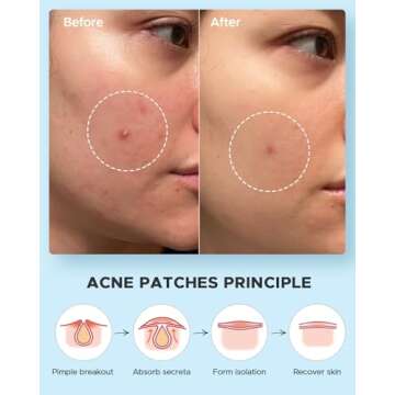 LitBear Acne Pimple Patches- Day and Night 4 Sizes 180 Dots Thin & Thick Hydrocolloid Patches with Witch Hazel, Tea Tree & Calendula Oil, Extra Adhesion for Face Zit Patch Dots