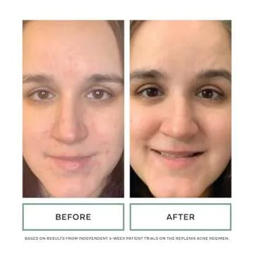 Replenix Gly-Sal 5-2 Clarifying Pads, Medical-Grade Exfoliating Cleansing Wipes for Acne-Prone Skin, Oil-Free Facial Treatment with Witch Hazel, 5% Glycolic & 2% Salicylic Acids (60 ct.)